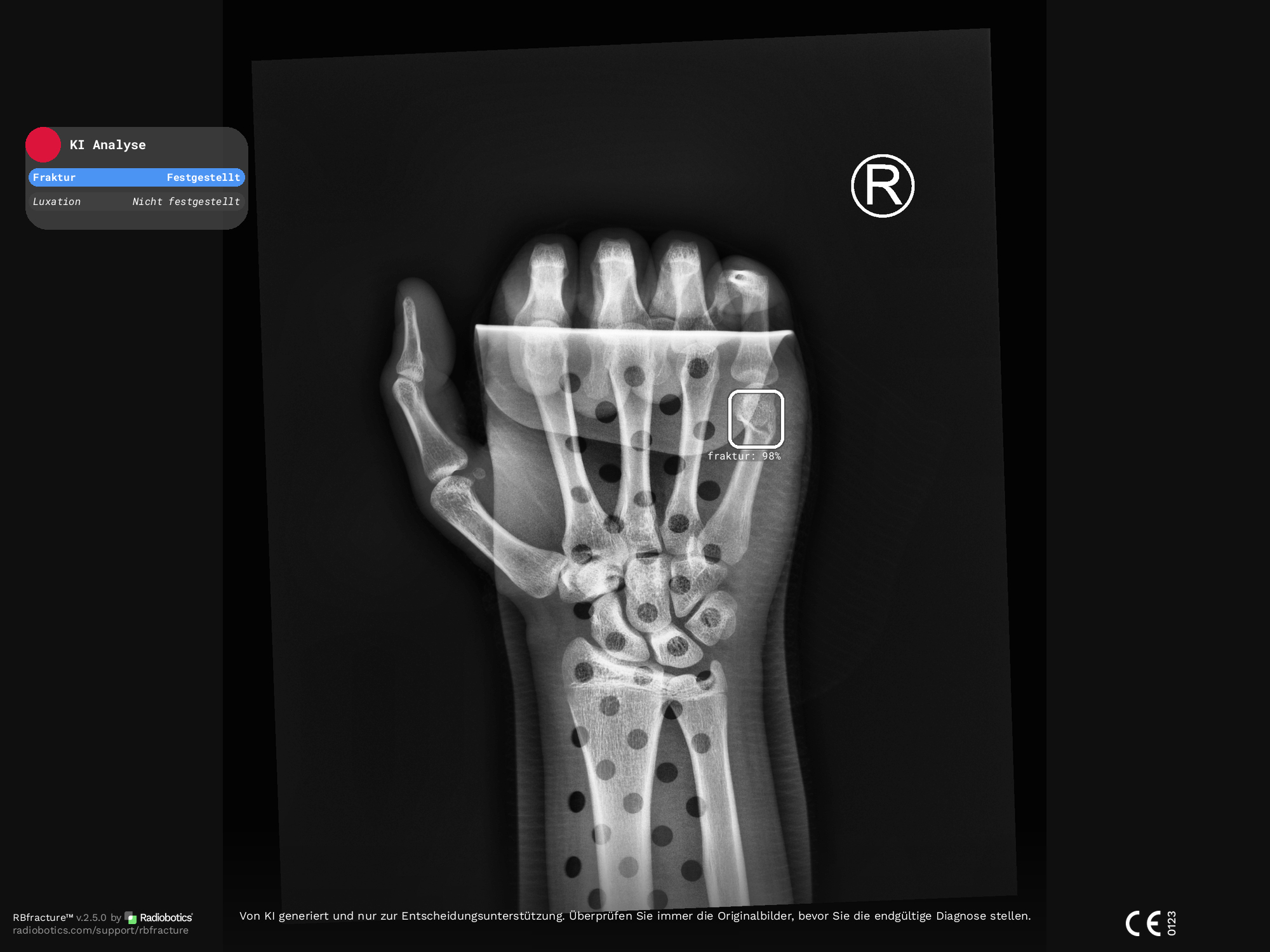 Main-Kinzig-Kliniken führen KI-gestützte Frakturerkennung ein